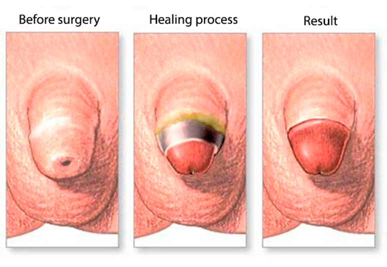 Penis recovery after circumcision