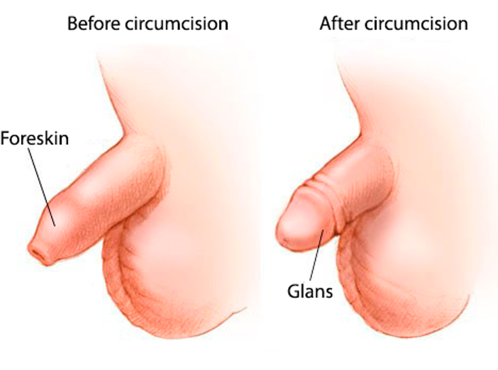 Penis vor und nach der Beschneidung